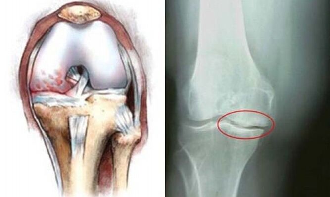 knee x-ray osteoarthritis