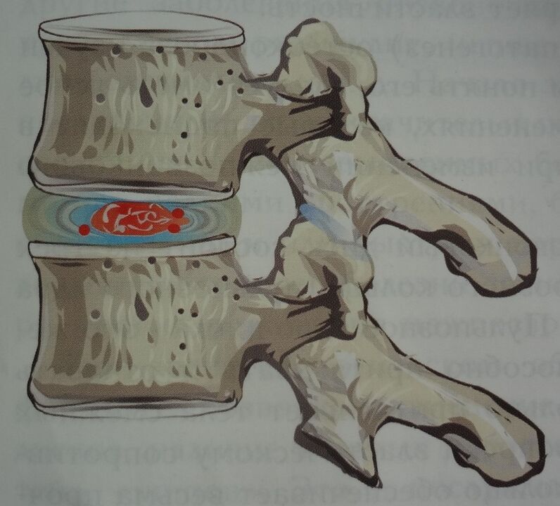 Damage to the pulposus nucleus of the intervertebral disc in the first stage of cervical osteochondrosis