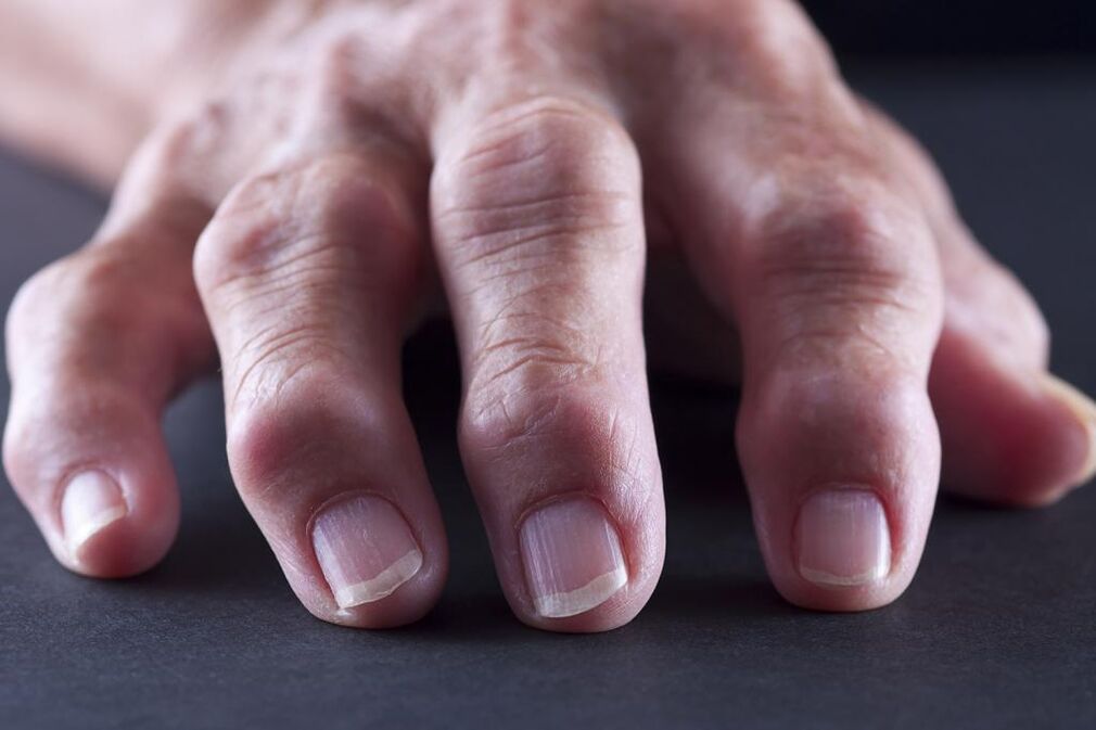Bursitis is characterized by pain, inflammation and swelling of the toe joints