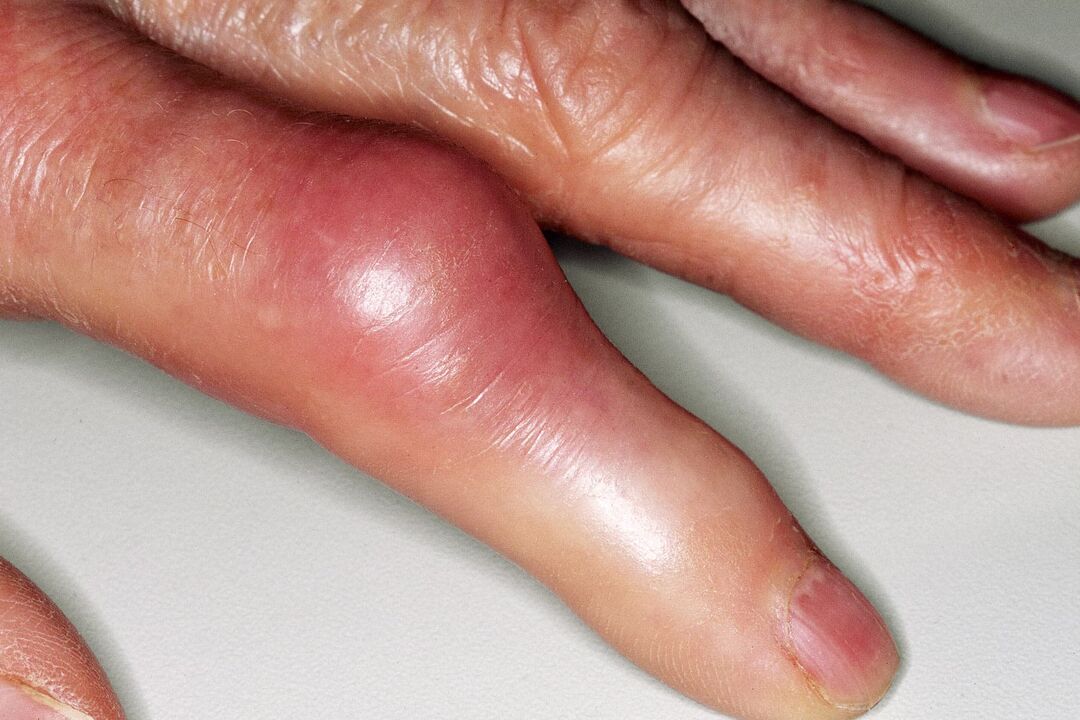 Swelling, deformity of the finger joint and acute pain after injury