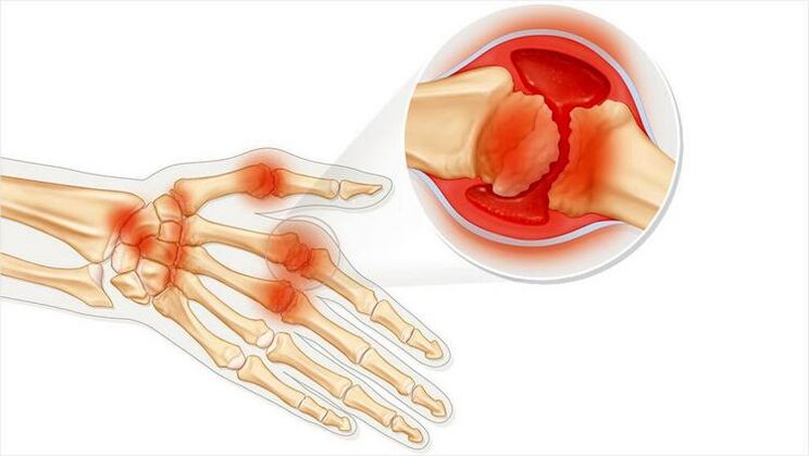 Hand joint damage due to arthritis