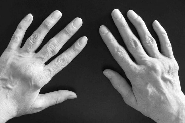 Symptoms of arthritis in the wrist joints