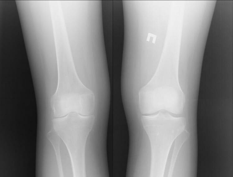 X-ray of knees affected by arthritis