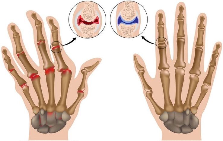 healthy wrist joints and arthritis damaged joints